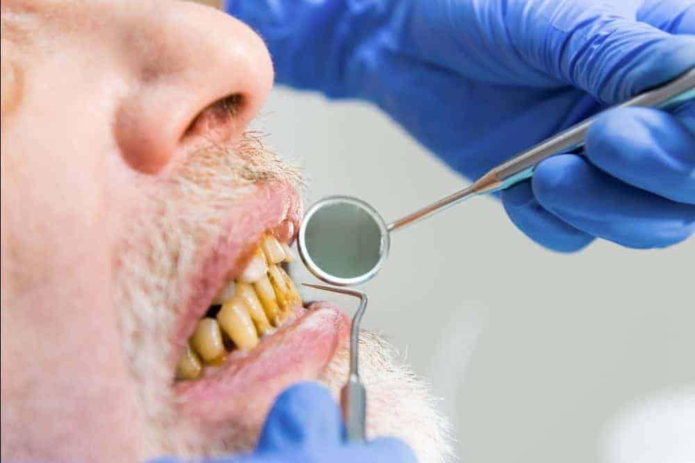 methamphetamine effects on teeth